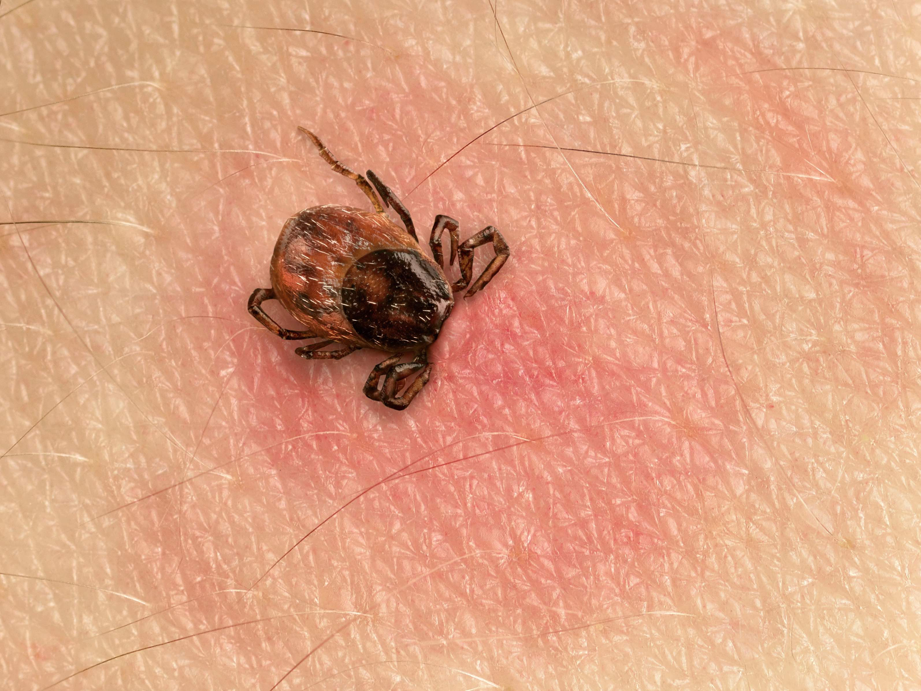 Lyme disease